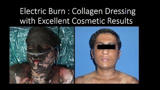 The Importance of Collagen in Open Wound Treatment | ProT Gold – ProT Gold  Collagen Protein