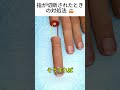 指が切断されたときの対処法 😱