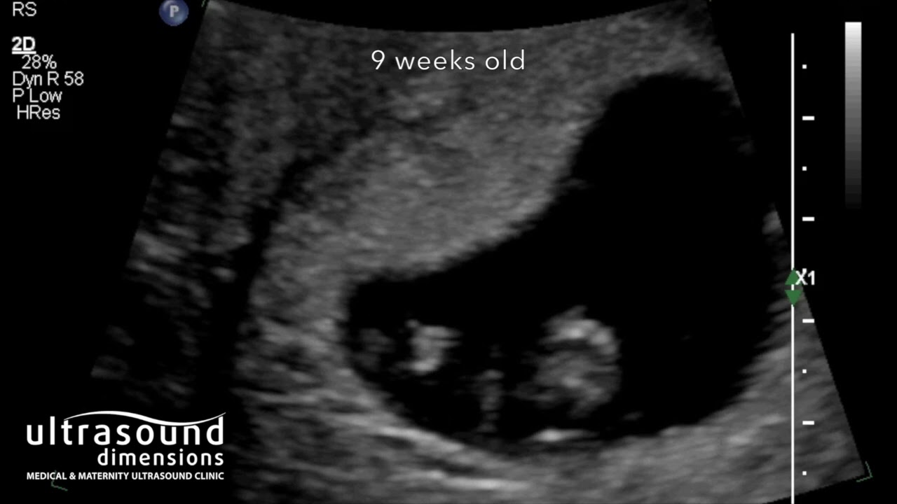 Week expect 9 what at ultrasound to What to