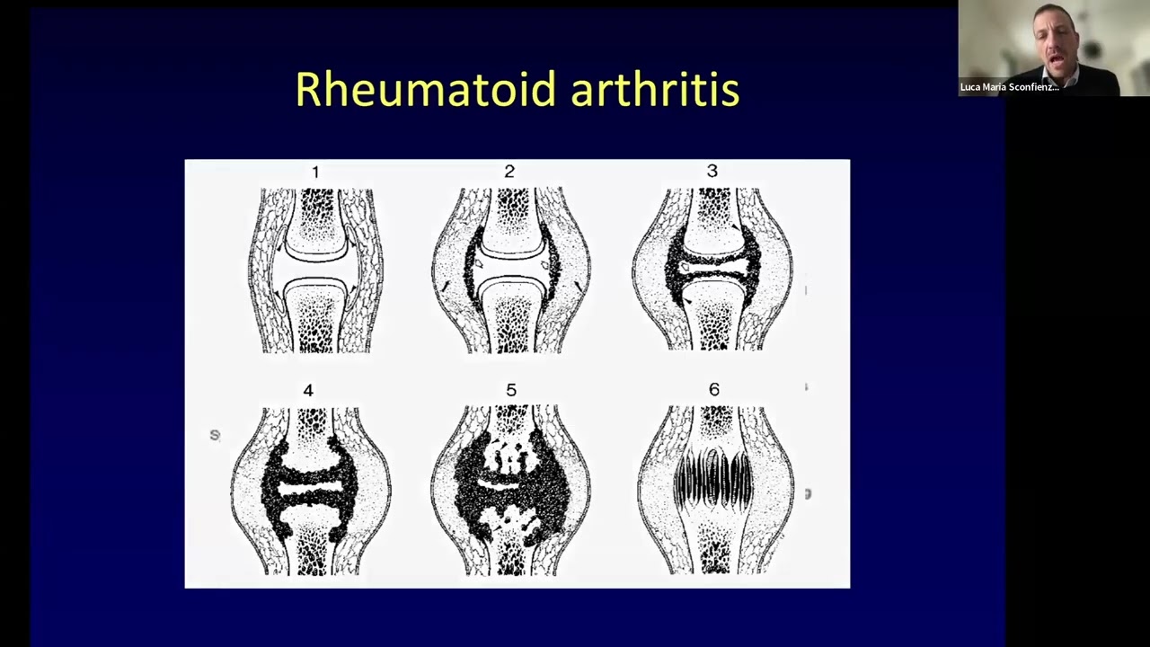 Patologia oncologica e infettiva dell'osso  - Prof. Sconfienza  e Prof. Guglielmi