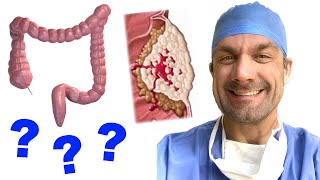 Colorectal Cancer Explained