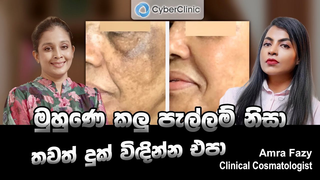 මුහුණෙ කලු පැල්ලම් නිසා තවත් දුක් විඳින්න එපා