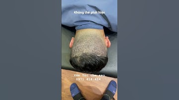 Xăm chân tóc che sẹo lấy tóc tự thân, kết quả bất ngờ không thể phát hiện