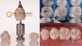 Intraoral dental acquisition (CS3600 Carestream) implant and crowns  scan - digital workflow