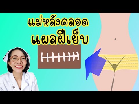 วีดีโอ: 3 วิธีในการดูแล Episiotomy หลังคลอด