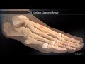 Cfs lisfranc ligament repair