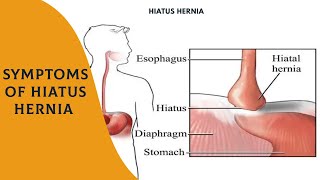 Most Common Symptoms Of Hiatus Hernia Best Surgeon Of Hernia Hernia Specialist Dr. Kapil Agrawal