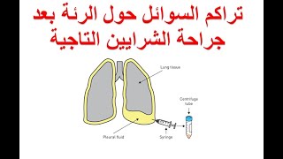 تراكم السوائل حول الرئة بعد جراحة الشرايين التاجية - الارتشاح البللوري او الانصباب الجنبي