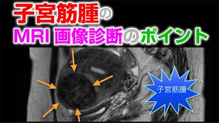 子宮筋腫の臨床 子宮筋腫のMRI画像診断のポイントは？症状、変性、種類は？