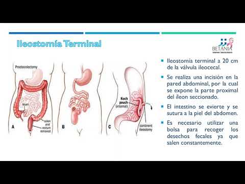 Video: ¿Por qué se realizan las ileostomías?