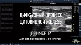 УЗИ щитовидной железы. Пример 19. Диффузный процесс. // Доктор Ушаков