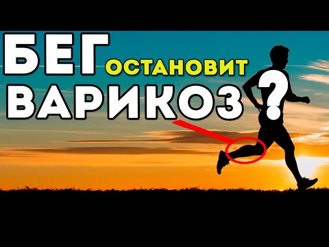 Пробежки и варикоз? Как остановить варикоз?