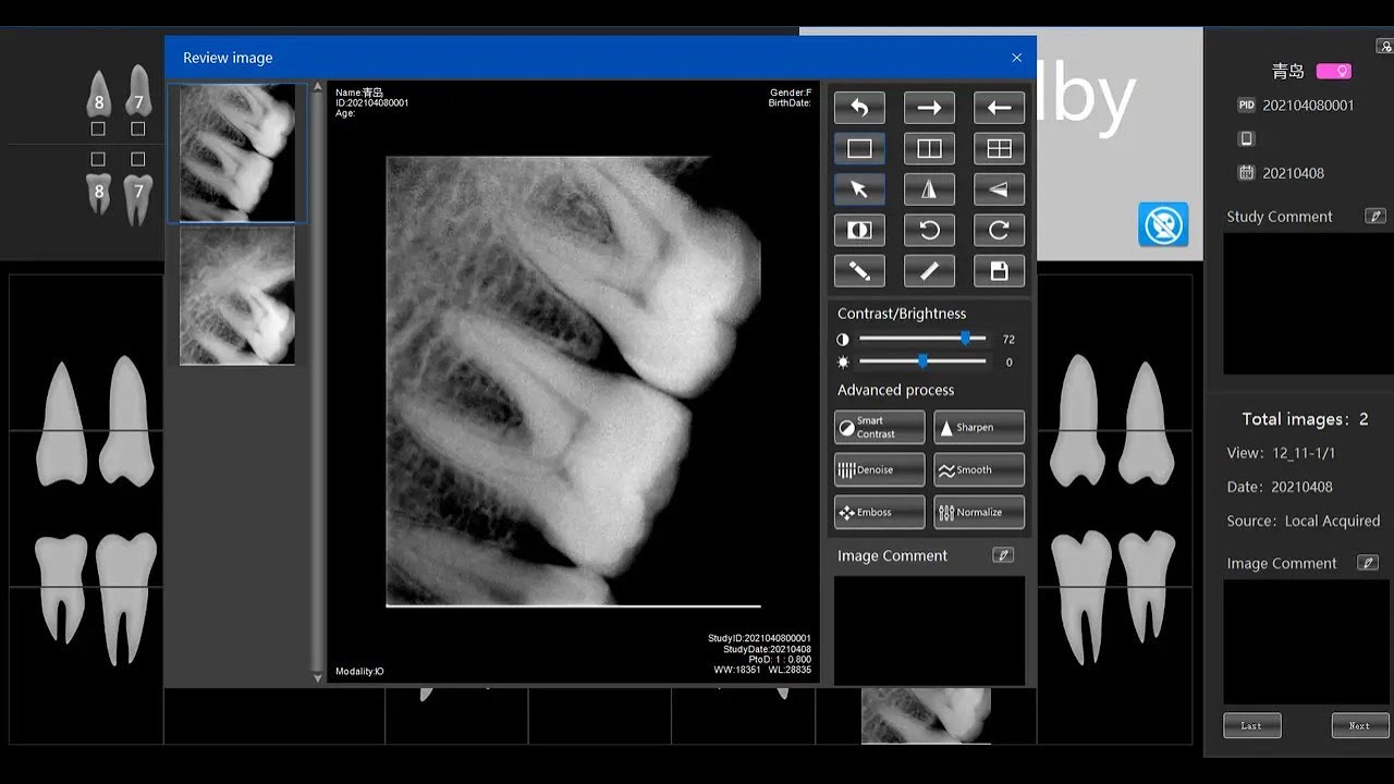 Цифровой визиограф Apple Dental Ecosensor. XVS2121 (Китай) YouTube