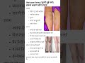 Varicose veins (फूली हुई नशे) इसके लक्षण और उपाय  #vericose #varicoseveins #veindisease #veins