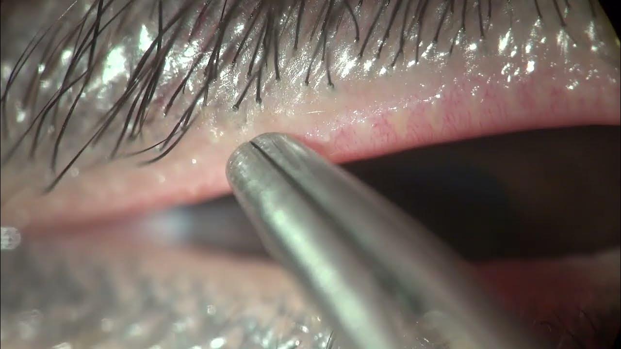 Trichiasis forceps and epilation YouTube