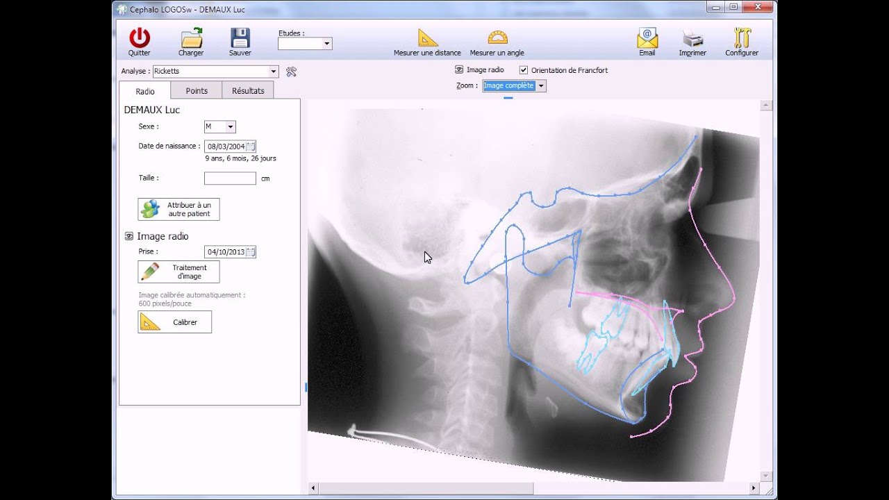 Logiciel de céphalométrie de LOGOSw