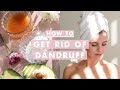 How to Get Rid of Dandruff | Home Remedies