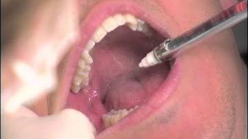 The Dental Box--Inferior Alveolar Nerve Block