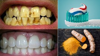 Blanchiment des dents à domicile en 2 minutes Comment blanchir ses dents jaunes naturellement