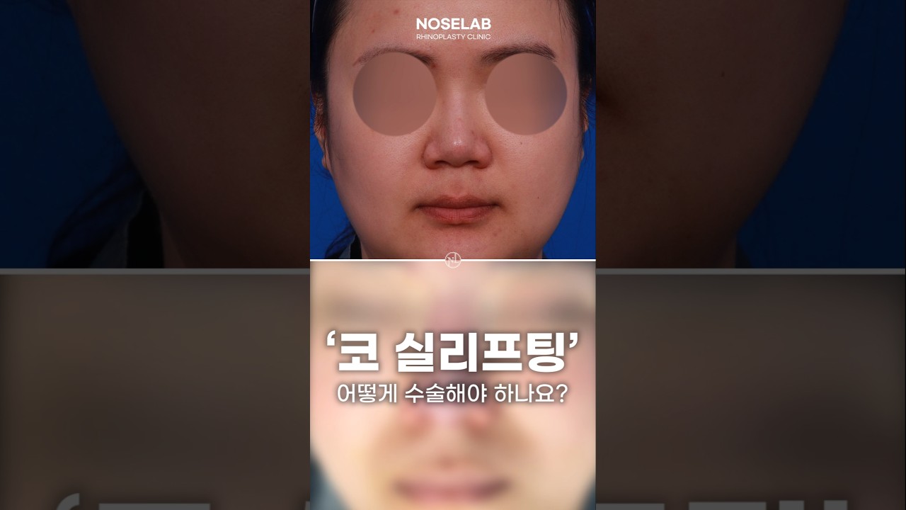 코매선 시술 후 불편감과 코성형 해결