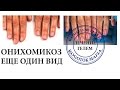 ОНИХОМИКОЗ КЛИНИЧЕСКИЙ. КАК ВЫЛЕЧИТЬ? Автор Елена Дзык