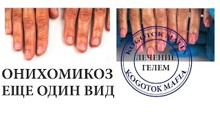 ОНИХОМИКОЗ КЛИНИЧЕСКИЙ. КАК ВЫЛЕЧИТЬ? Автор Елена Дзык ОНИХОМИКОЗ КЛИНИЧЕСКИЙ. КАК ВЫЛЕЧИТЬ? Автор Елена Дзык