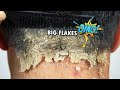 Psoriasis Scalp Scratching Big Flakes #610