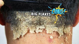 Psoriasis Scalp Scratching Big Flakes #610