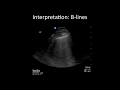 Lung ultrasound common pitfalls