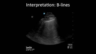 Lung Ultrasound: Common Pitfalls