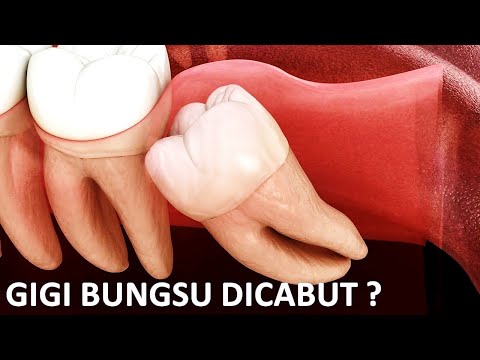 Video: Adakah gigi geraham bungsu yang tumbuh lebih mudah dicabut?