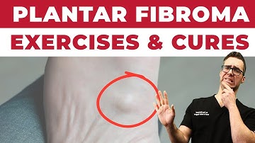 Plantar Fibroma Home Treatment [BEST Exercises & Remedies 2024]