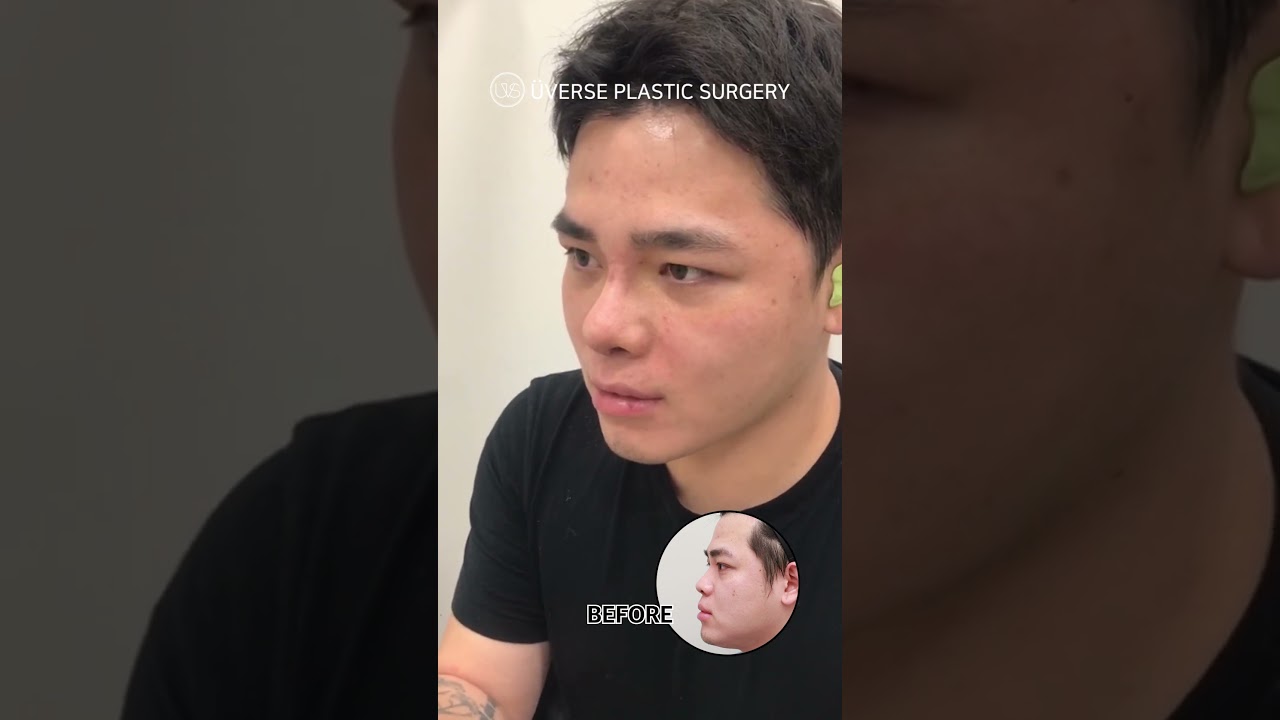 [Вэвэрс Клиник] Эрэгтэй хамар 7 хоногтой гипс тайлах 💚