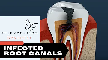 Infected Root Canals Can Be Major Sources Of Chronic Inflammation And Toxicity!