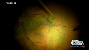 OPTRONICS MICROCAST 4K PRO - Ophthalmic Retina Microscope Video 1
