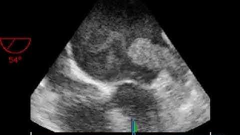 left atrial appendage thrombus and spontaneous echo contrast