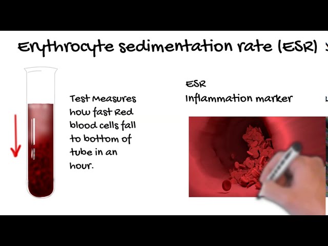 How to Reduce Erythrocyte Sedimentation Rate(ESR)
