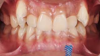 Bracesorthodontic Treatment Journey Before & After Transformation 3Rd Video Results
