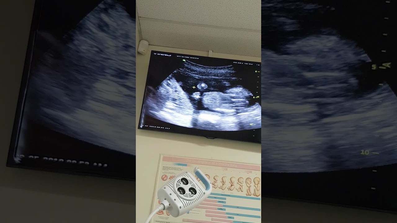 Baby 3 ultrasound YouTube