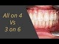 All-on-4 vs 3-on-6 Whats Better For a Full Set of Teeth on Dental Implants