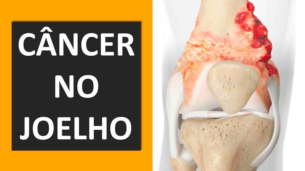 CÂNCER NO JOELHO – O QUE VOCÊ PRECISA SABER