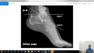 شرح كل كسور استقبال العظام فى ساعتين :: [12] Calcaneus Fracture