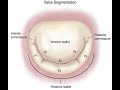 Du cpc m3c necker universit de paris malformations mitrales et autres anomalies mitrales de lenfa