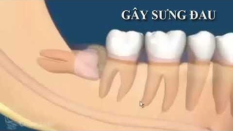 RĂNG KHÔN VÀ NHỮNG BIẾN CHỨNG CỦA MỌC RĂNG KHÔN.. ! |phần 1| #ranghamnho