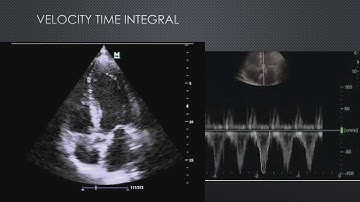 IGNITE! Session 1- Fluid Responsiveness: The IVC and Beyond