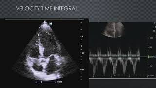IGNITE! Session 1- Fluid Responsiveness: The IVC and Beyond
