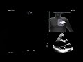 Vscan Air™ | Caption AI™ Static Guidance