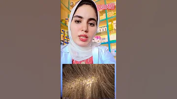 أنواع القشرة جافة دهنية القشرة الجافة القشرة الدهنية القشرة الطب المبسط Dr Basma Shafek 