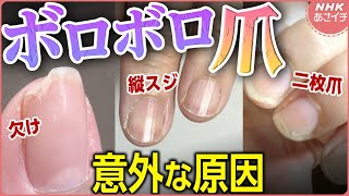 【必見】ボロボロ爪 意外な原因＆美爪になるスペシャルケアも！| あさイチ | NHK
