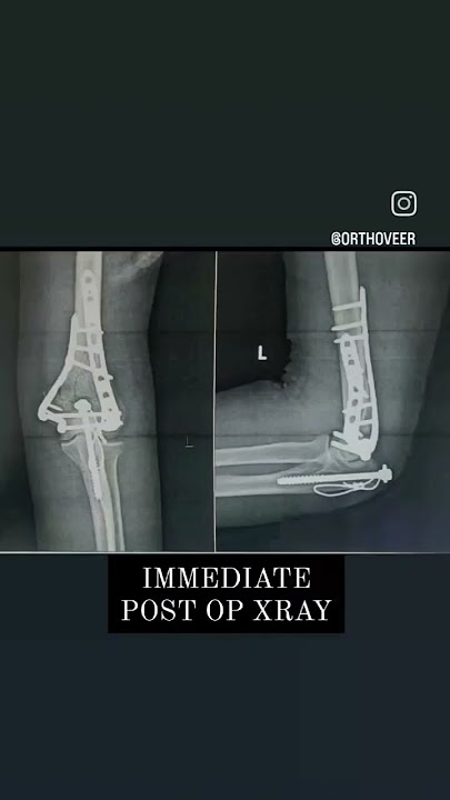Distal Humerus intra-articular # managed with ORIF with ulnar chevron osteotomy and dual plating.